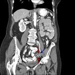 Acute diverticulitis