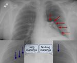 Large Pneumothorax