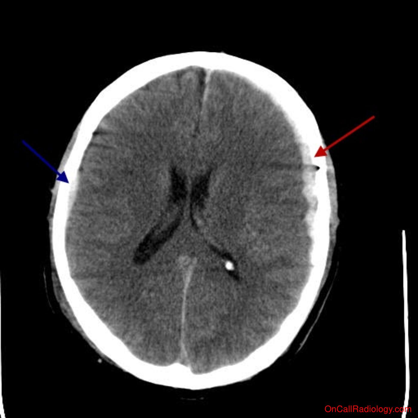 Head (Bilateral subdural hematomas and parenchymal bleed - CT)