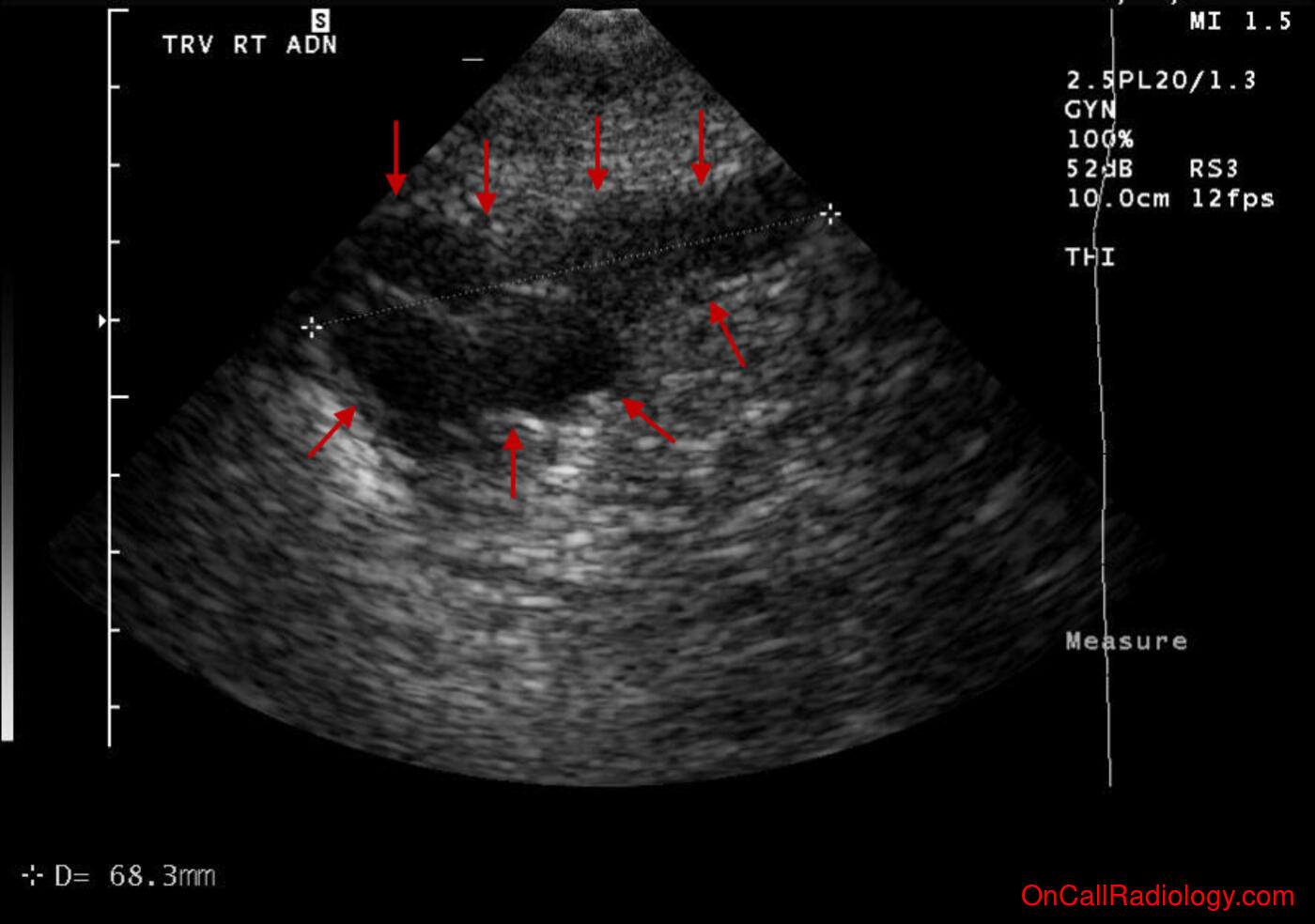 Female (Right hydrosalpinx and uterine fibroids - Ultrasound, CT)