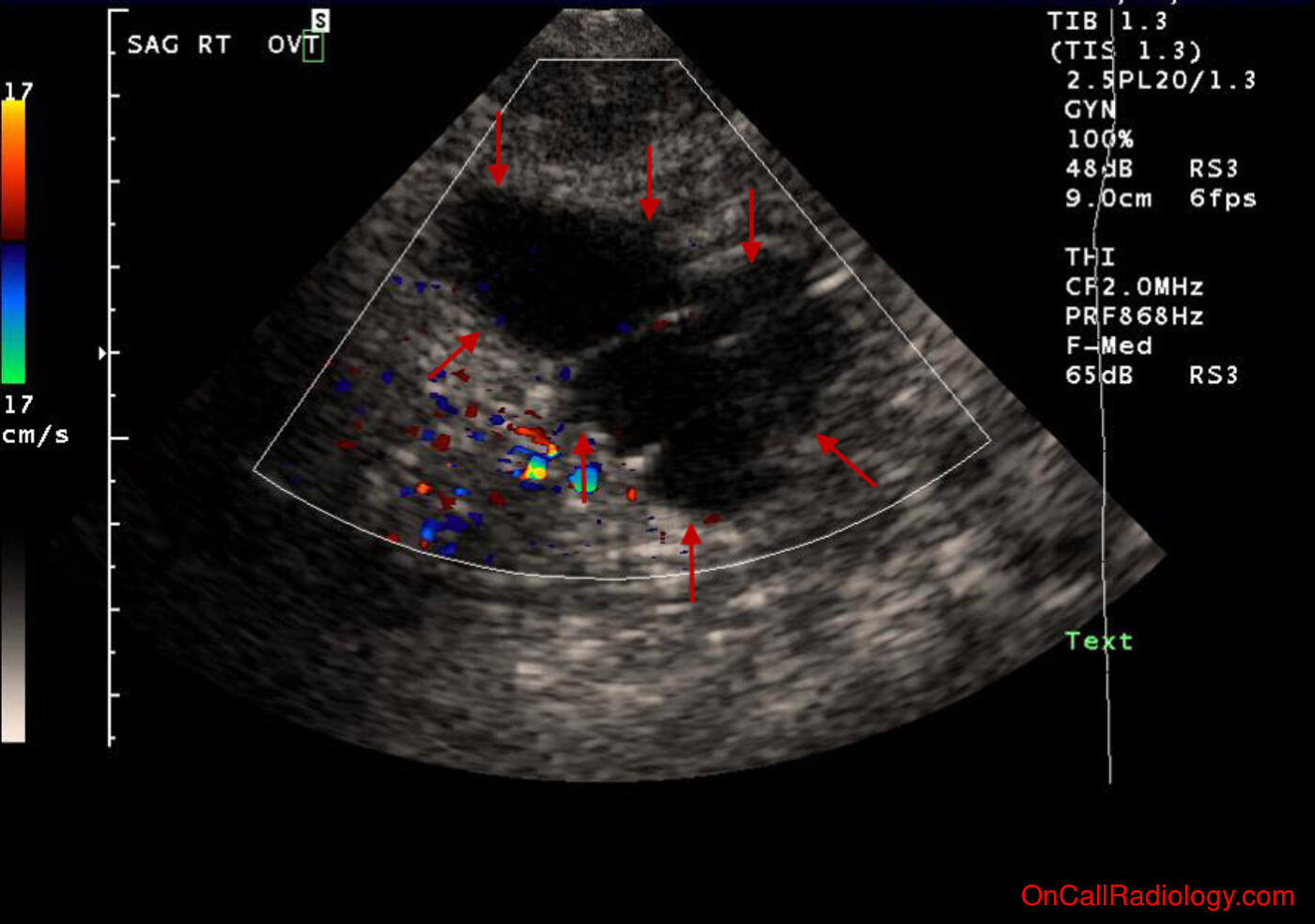 Female (Right hydrosalpinx and uterine fibroids - Ultrasound, CT)