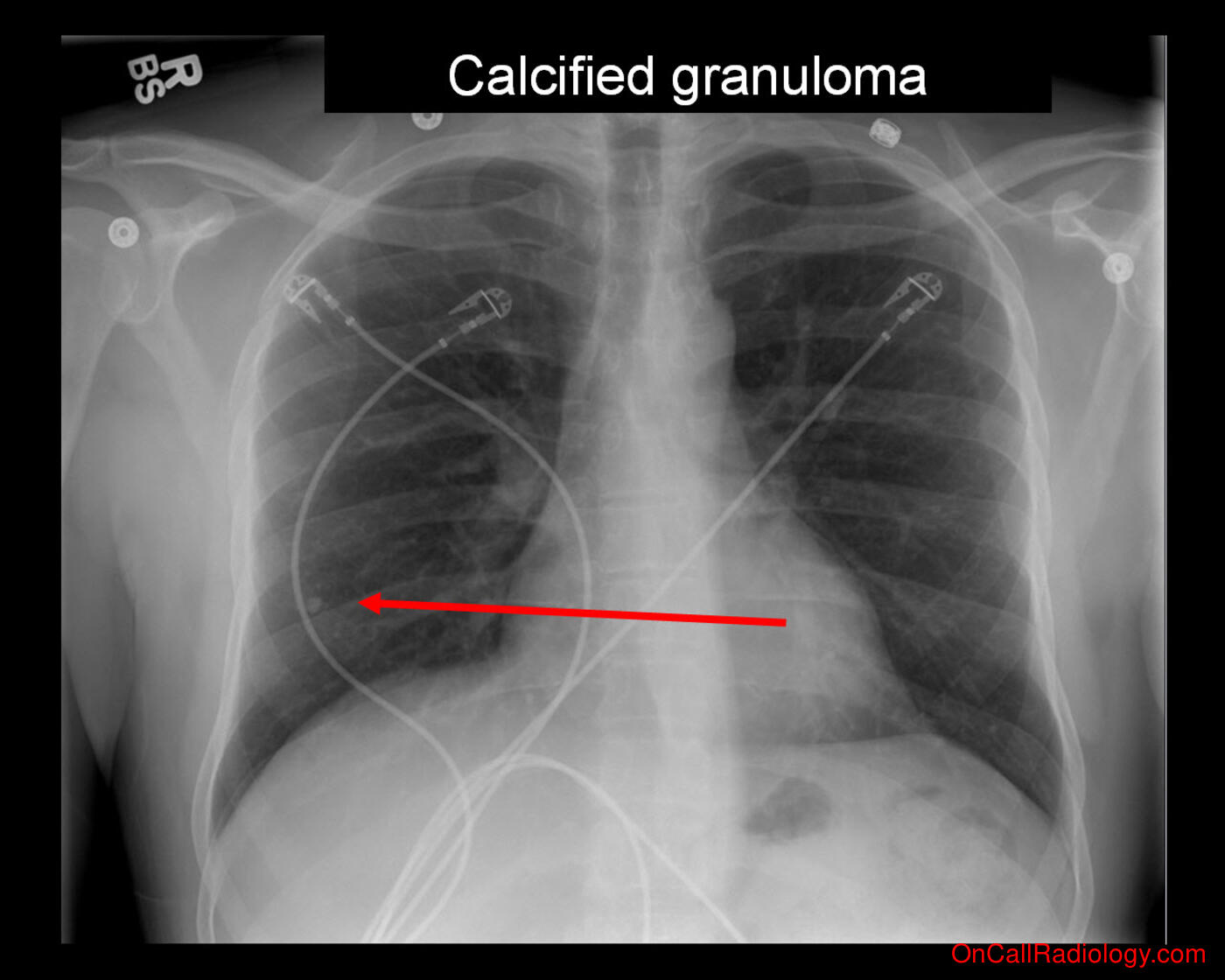 Harmless (Calcified Granuloma - Plain film, Radiograph)