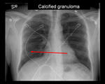 Calcified Granuloma