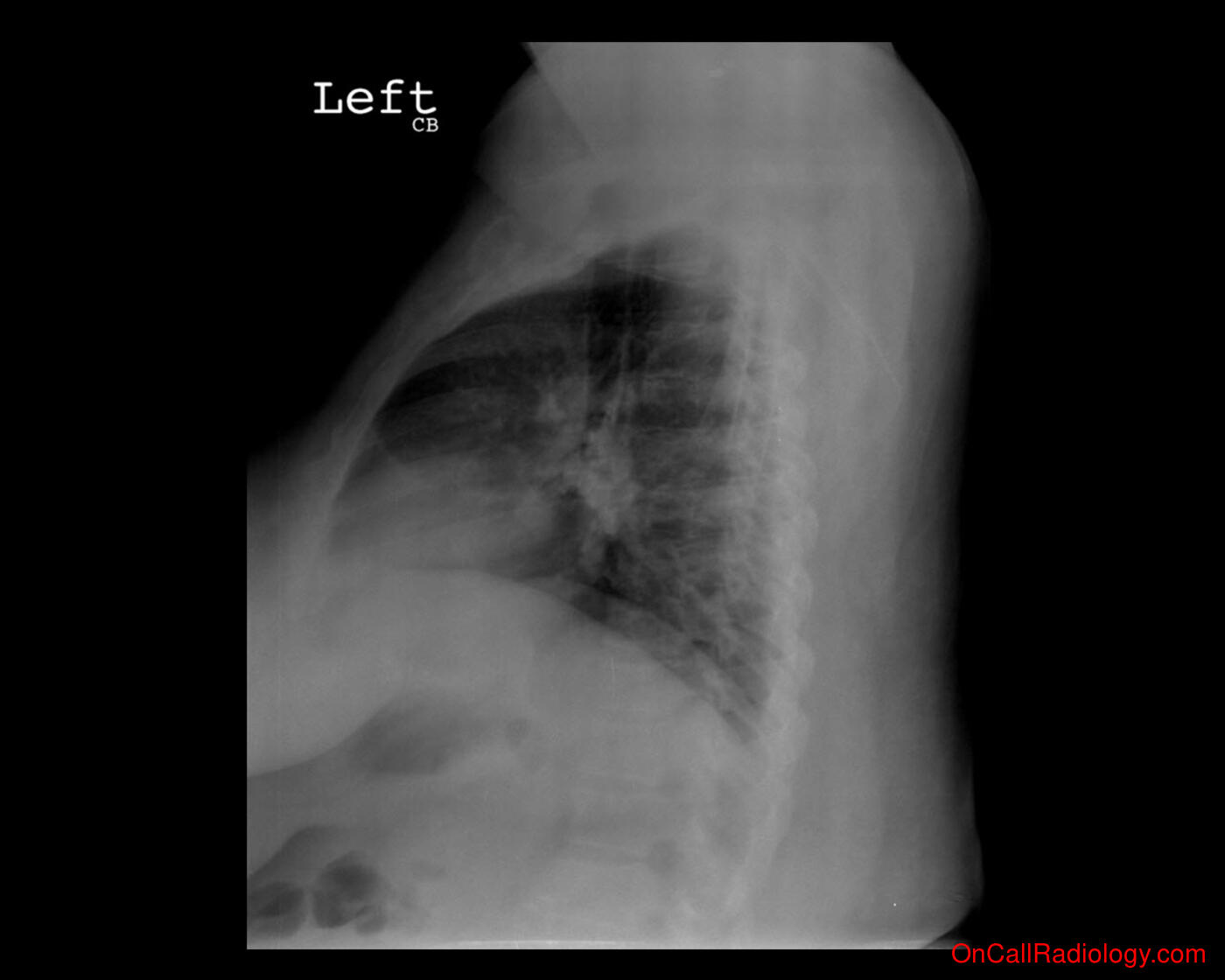 Harmless (Calcified lymph nodes - Plain film, Radiograph, CT, Computed tomography)