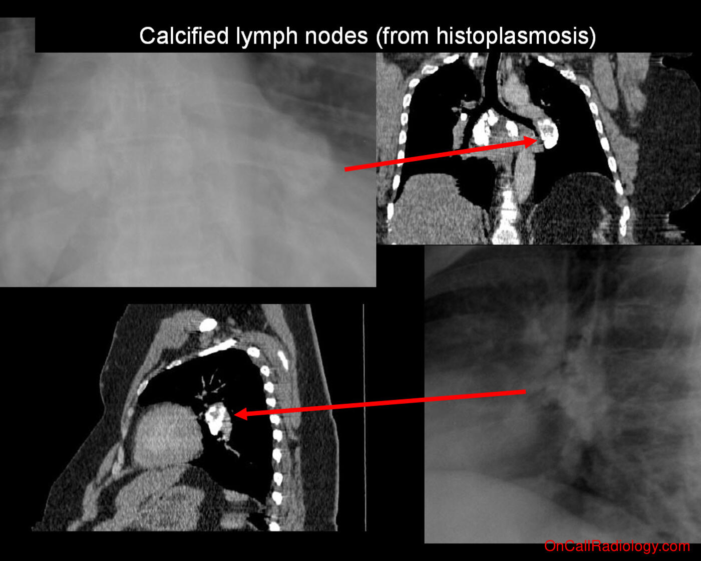 Harmless (Calcified lymph nodes - Plain film, Radiograph, CT, Computed tomography)
