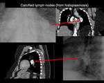 Calcified lymph nodes