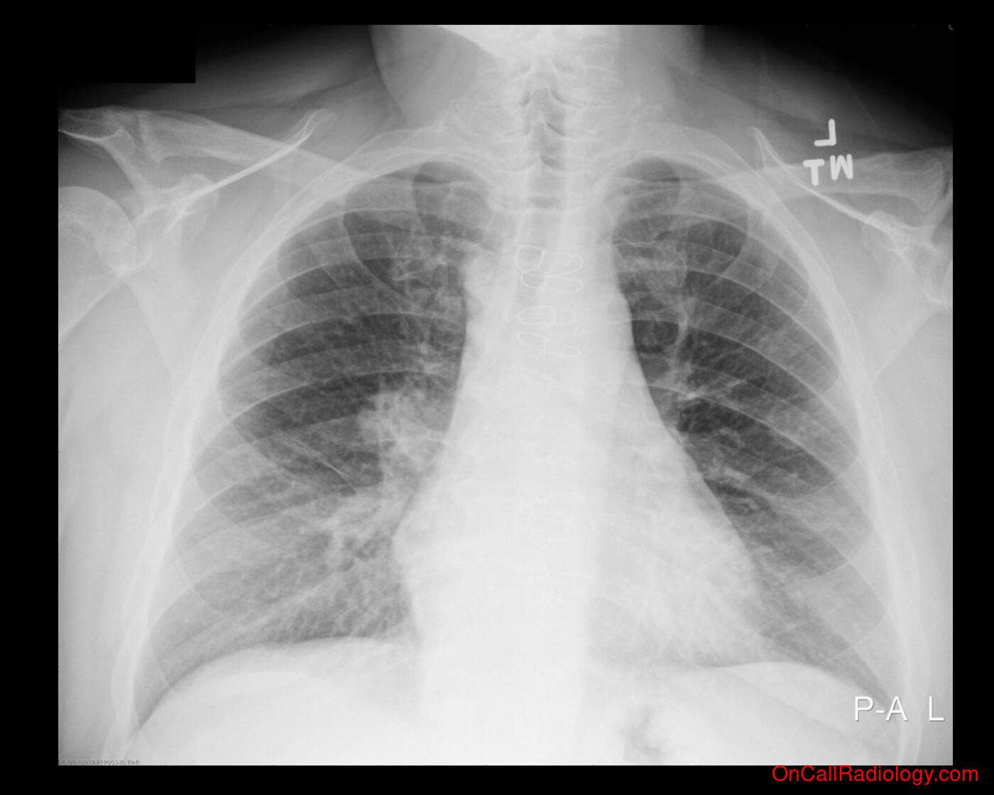 Cancer (Lung cancer - Plain film, Radiograph)