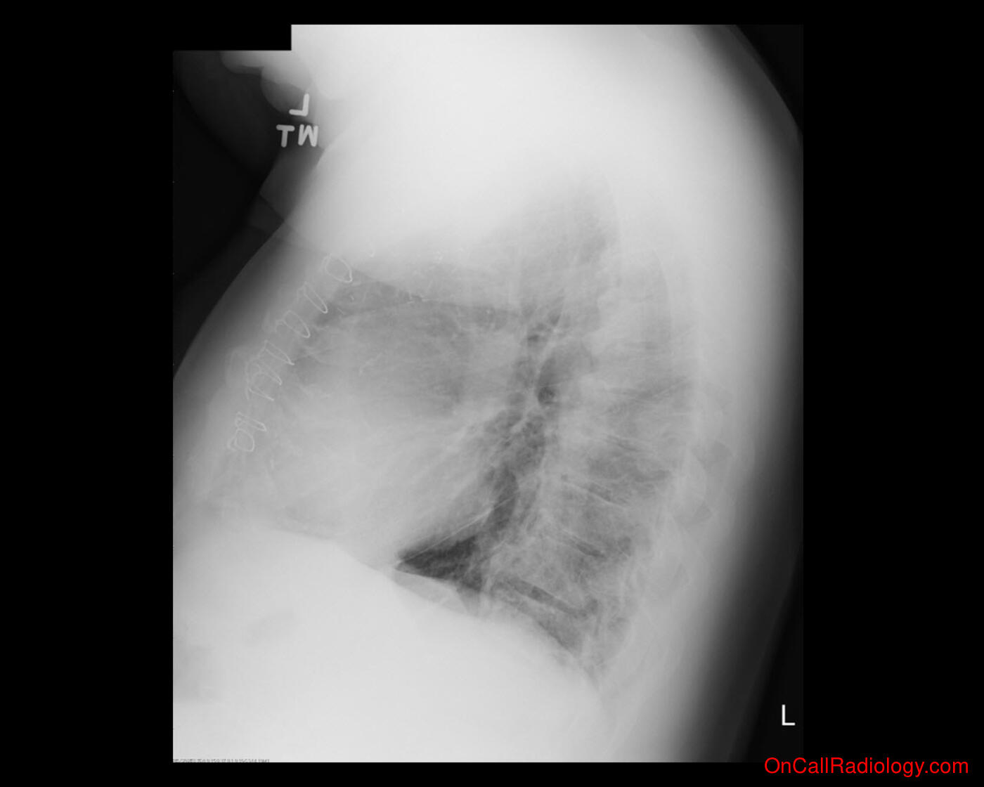Cancer (Lung cancer - Plain film, Radiograph)