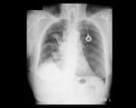 Large pneumothorax