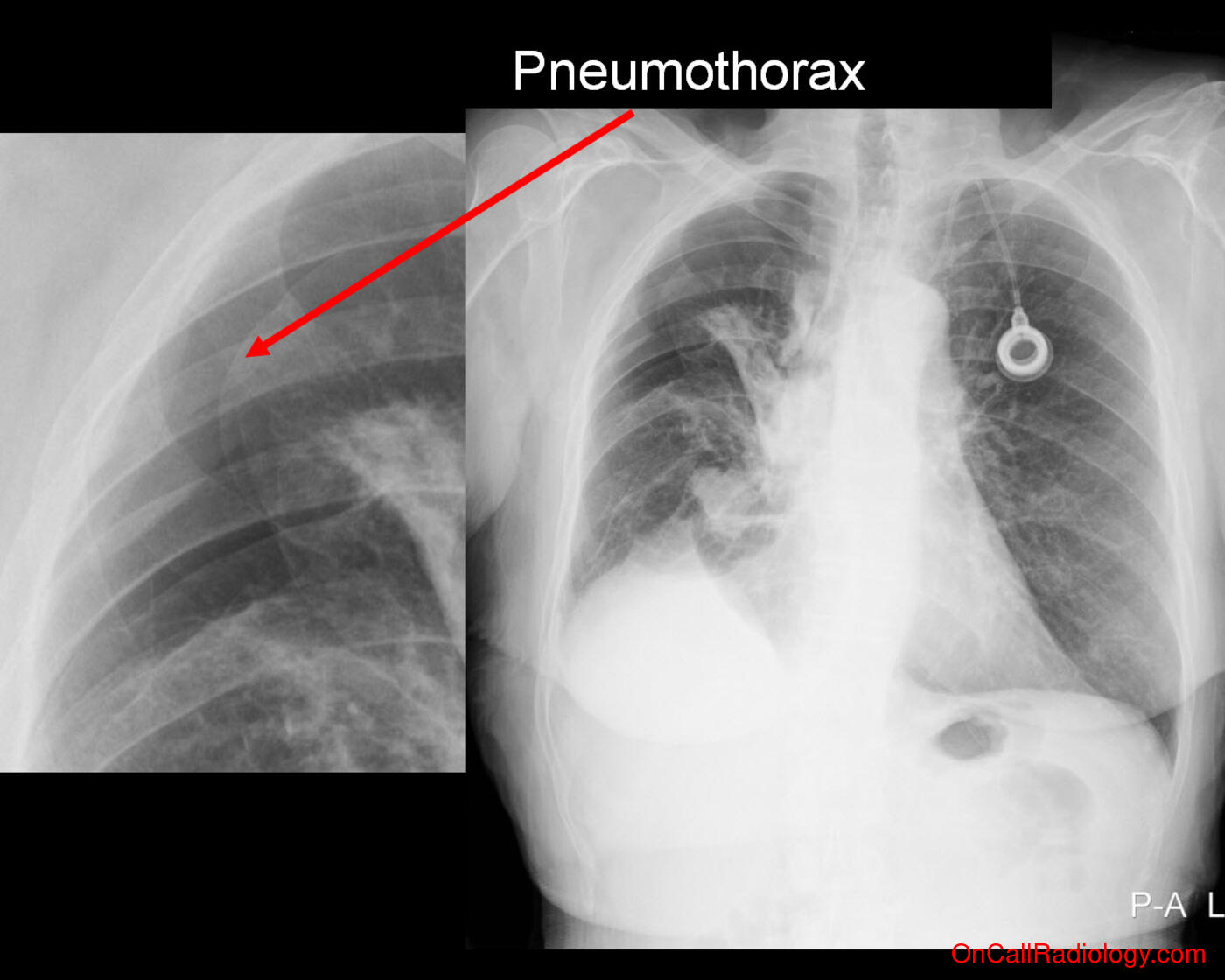 Pneumothorax (Large pneumothorax - Plain film, Radiograph)
