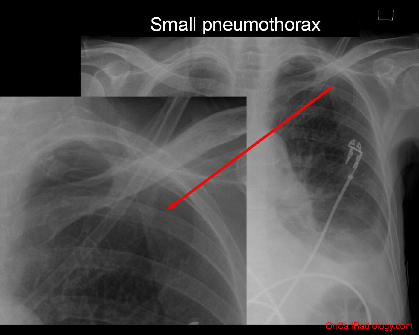 Pneumothorax (Small pneumothorax - Plain film, Radiograph)