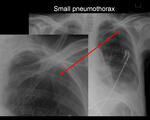 Small pneumothorax