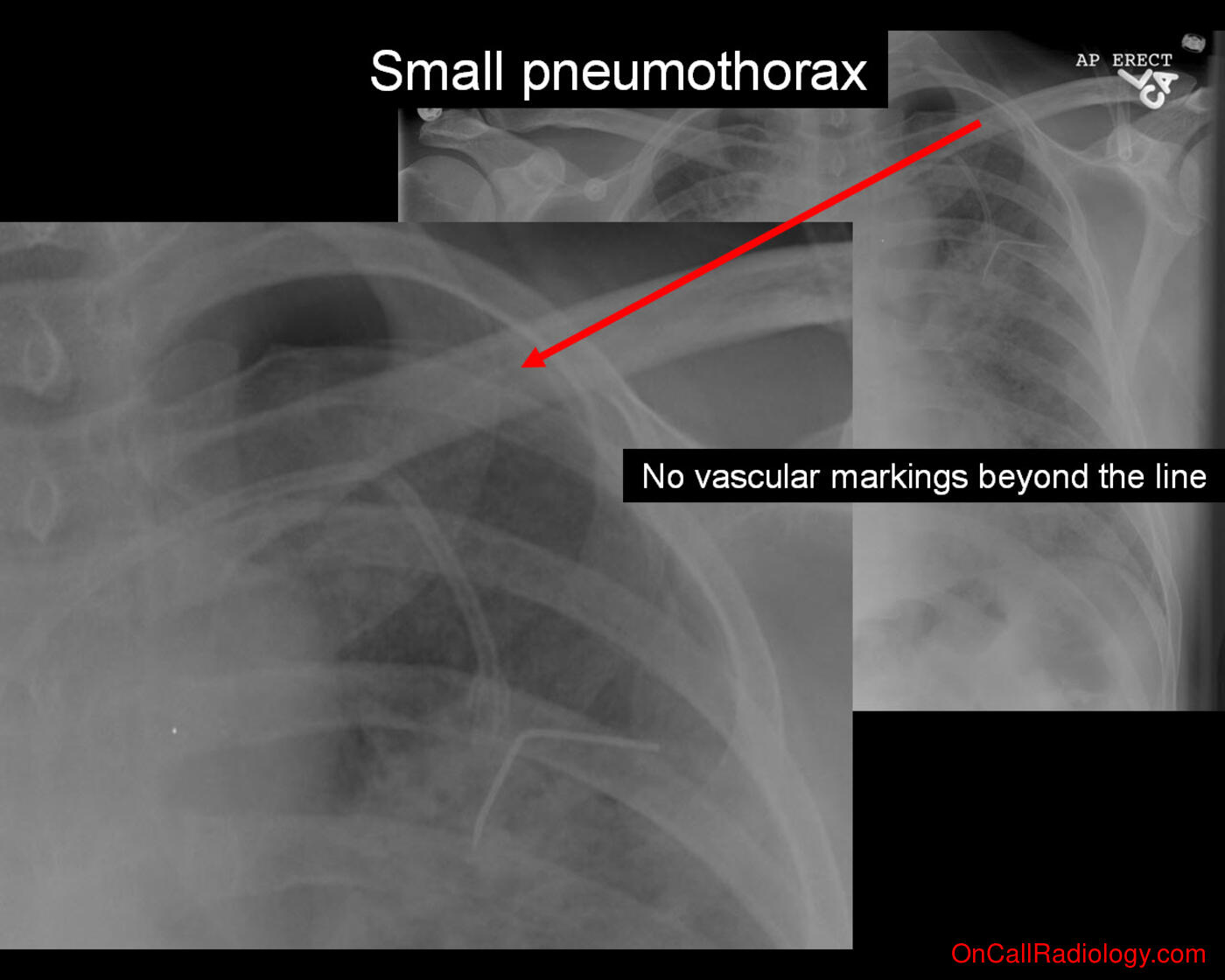 Pneumothorax (Small pneumothorax - Plain film, Radiograph)
