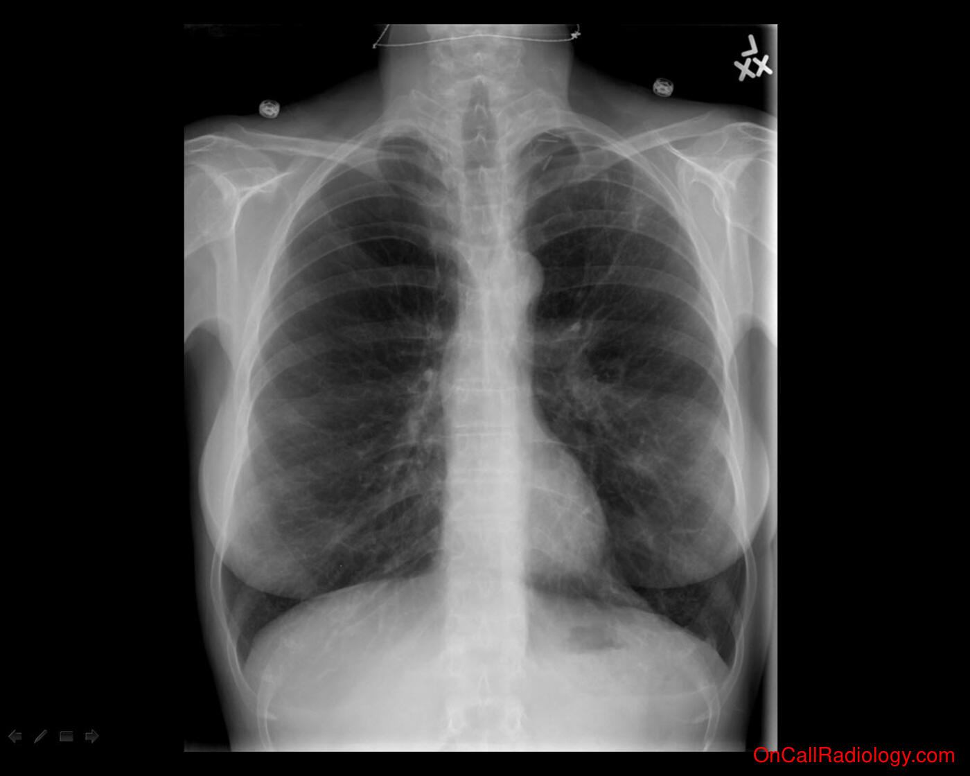 Pneumothorax (Small costophrenic pneumothorax - Plain film, Radiograph)