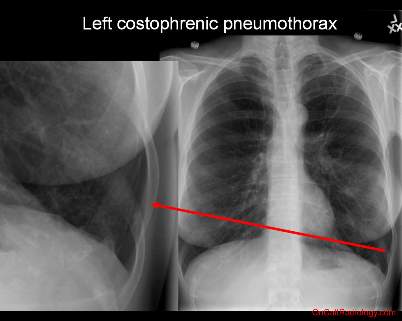 Pneumothorax (Small costophrenic pneumothorax - Plain film, Radiograph)
