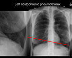 Small costophrenic pneumothorax