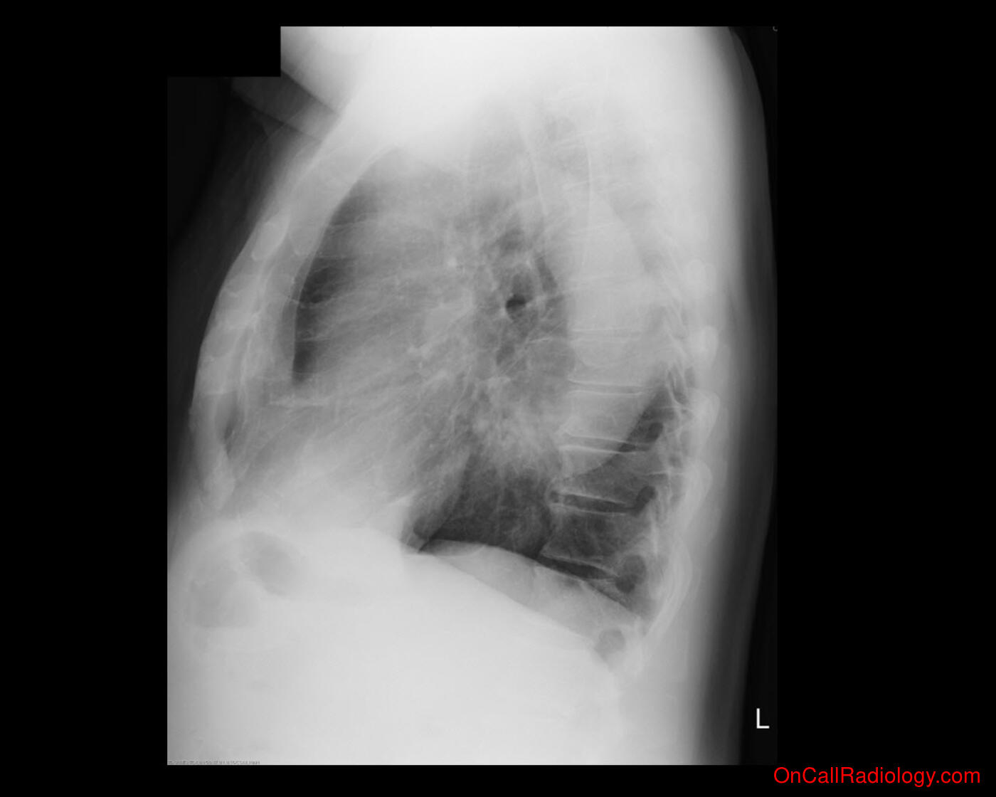 Aorta (Aortic aneurysm - Plain film, Radiograph, CT, Computed tomography)
