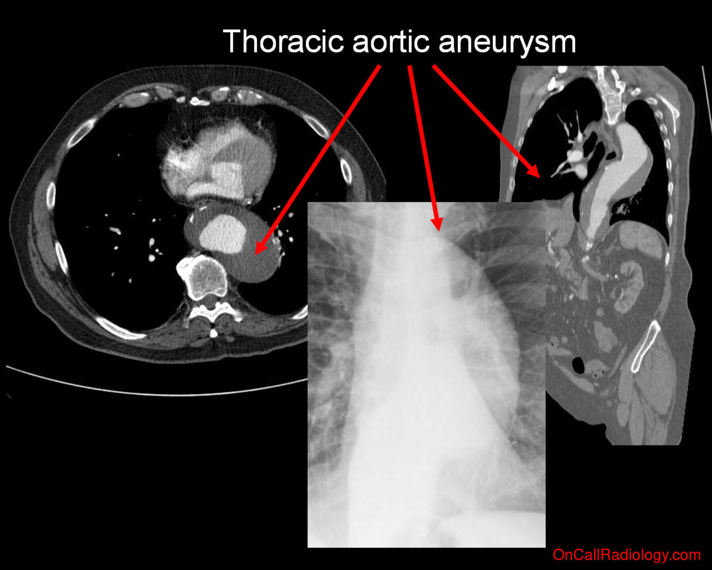 Aorta (Aortic aneurysm - Plain film, Radiograph, CT, Computed tomography)