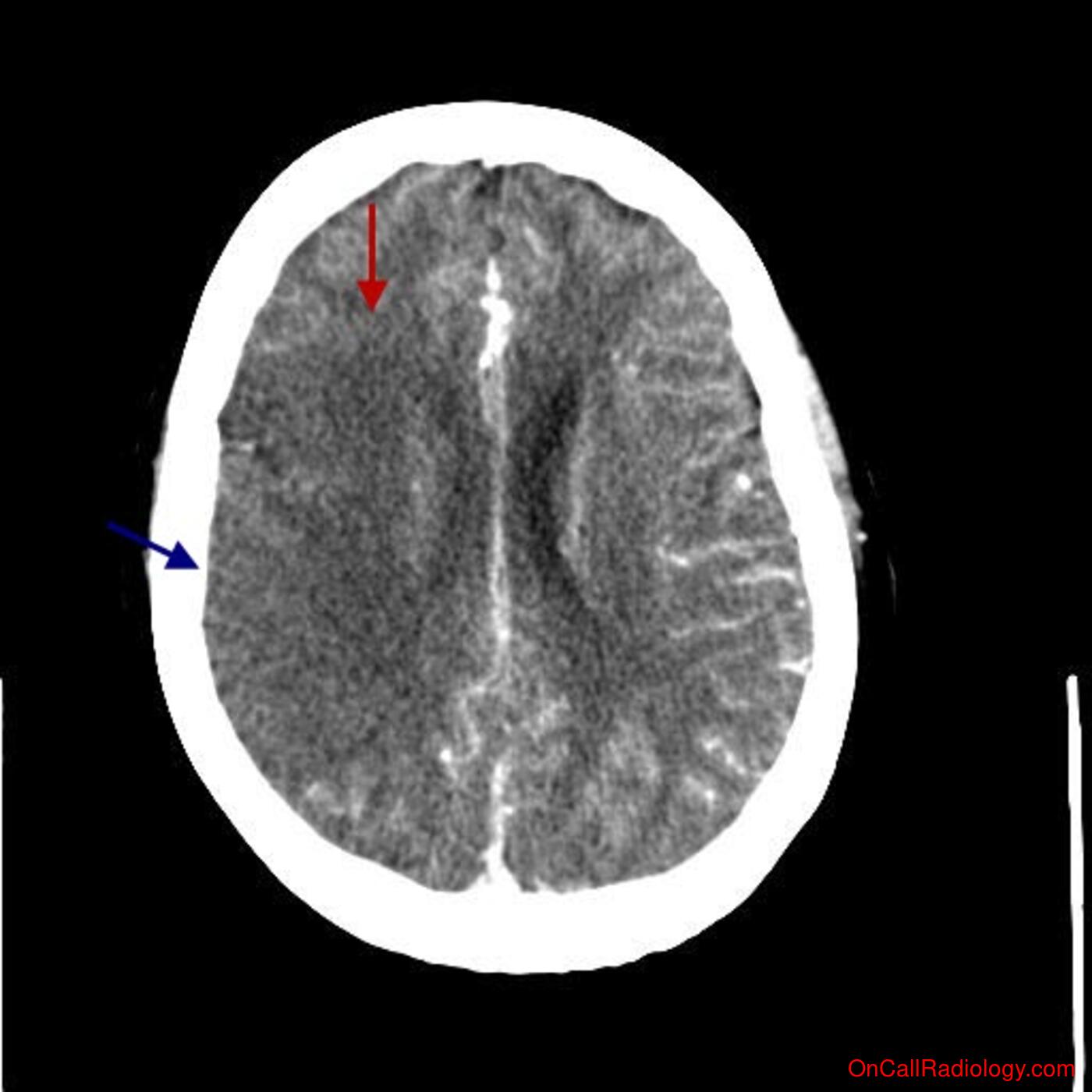 Head (Acute right MCA stroke - CTA, CT)