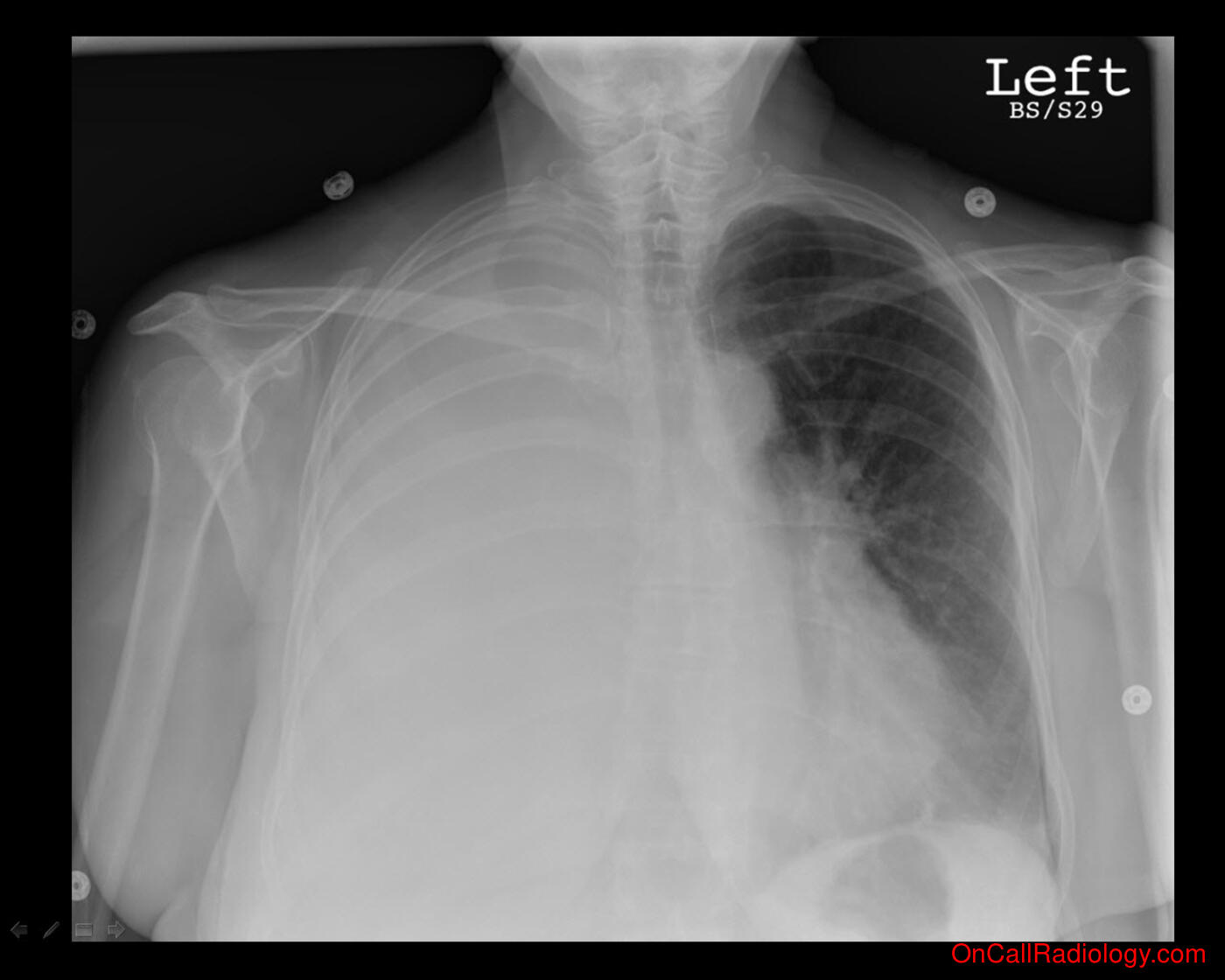 Fluid (Pleural effusion - Plain film, Radiograph, CT, Computed tomography)