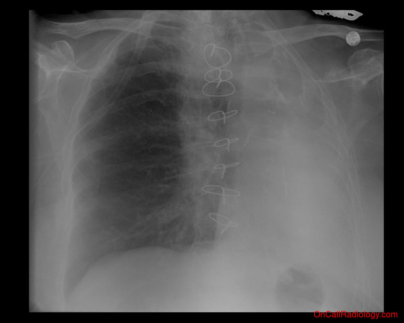 Lung volume (Volume loss  - Plain film, Radiograph)