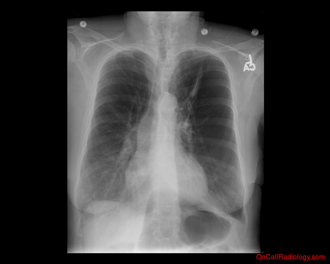 Lung volume (Obstructive lung disease - Plain film, Radiograph)