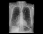 Obstructive lung disease
