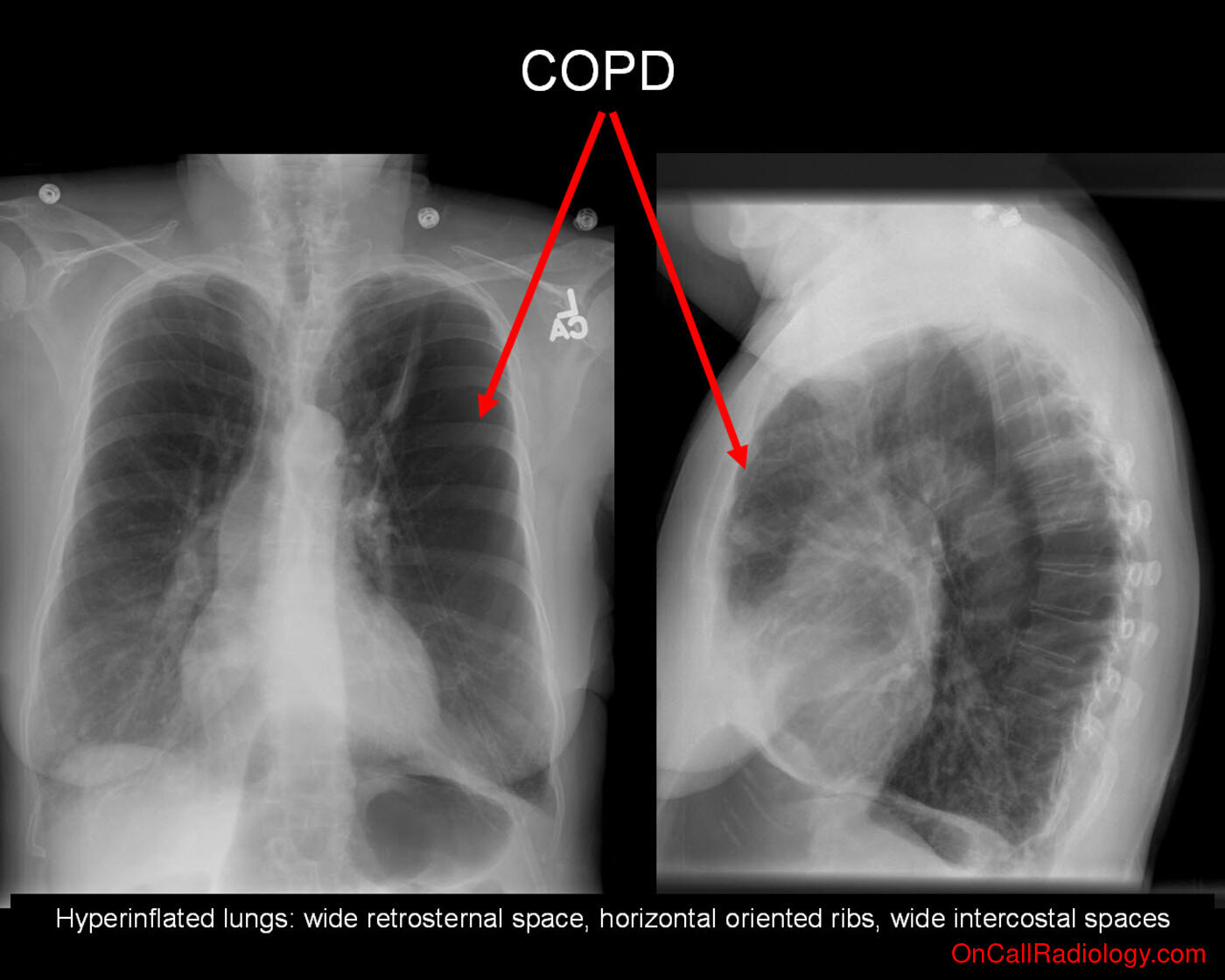 Lung volume (Obstructive lung disease - Plain film, Radiograph)
