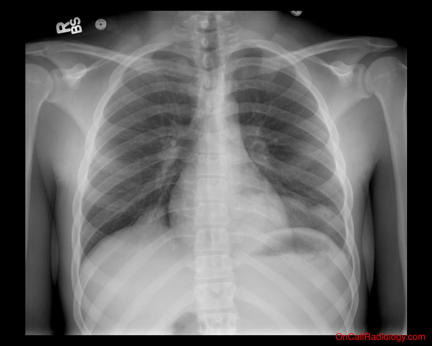 Pneumonia (Left and right lower lobe pneumonia  - Plain film, Radiograph)