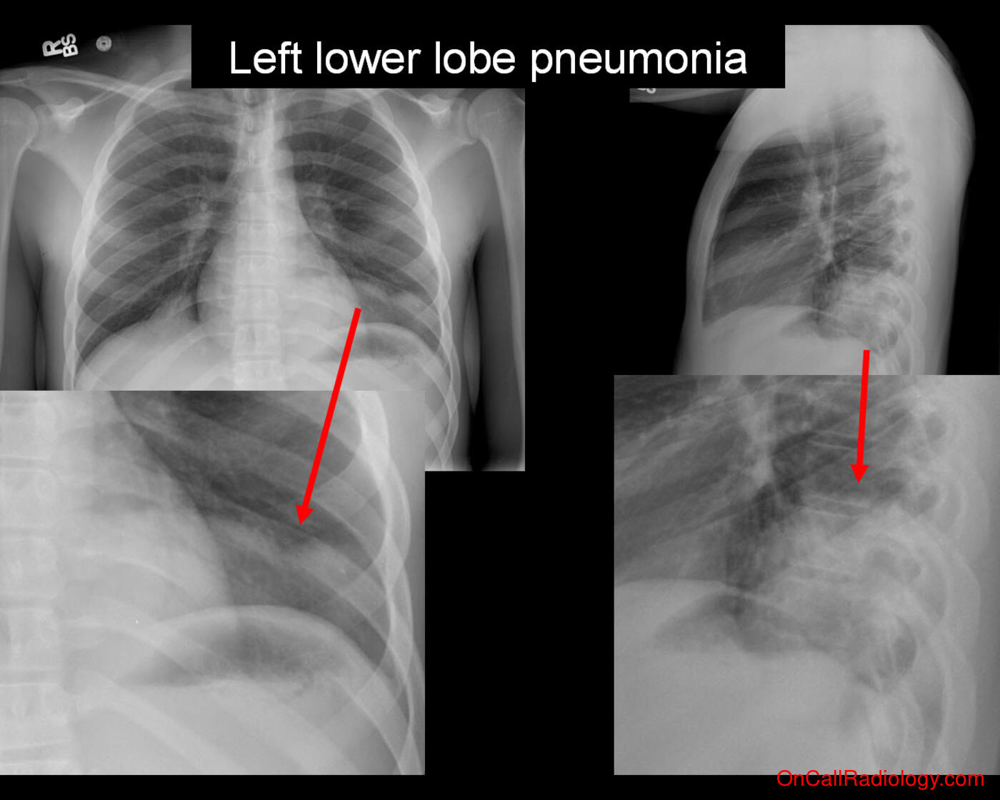 Pneumonia (Left and right lower lobe pneumonia  - Plain film, Radiograph)