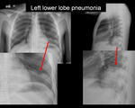 Left and right lower lobe pneumonia 