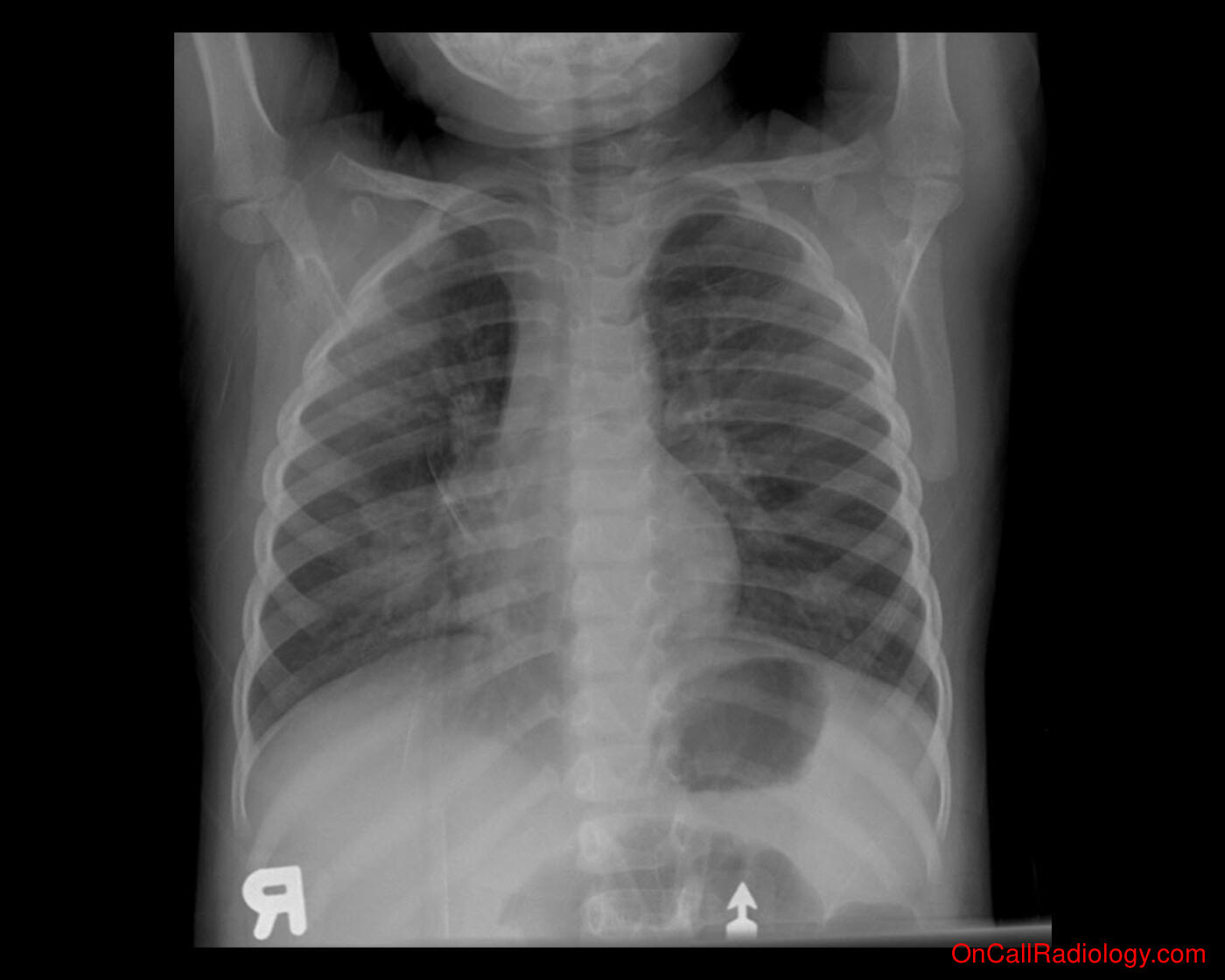 Pneumonia (Right middle lobe pneumonia  - Plain film, Radiograph)