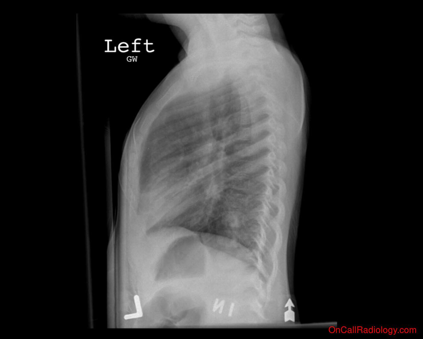 Pneumonia (Right middle lobe pneumonia  - Plain film, Radiograph)