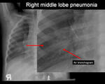 Right middle lobe pneumonia 