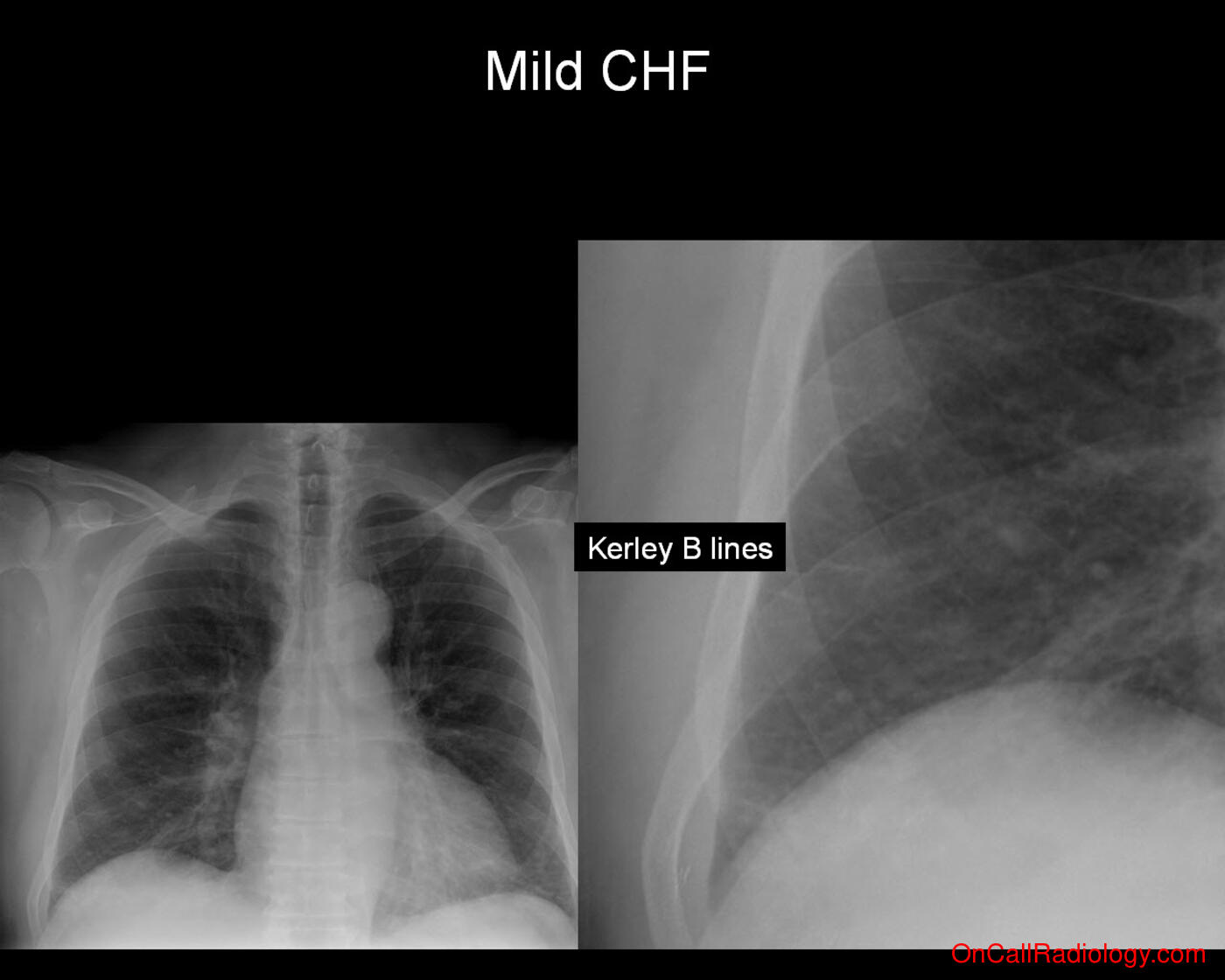 CHF (Mild CHF - Plain film, Radiograph)