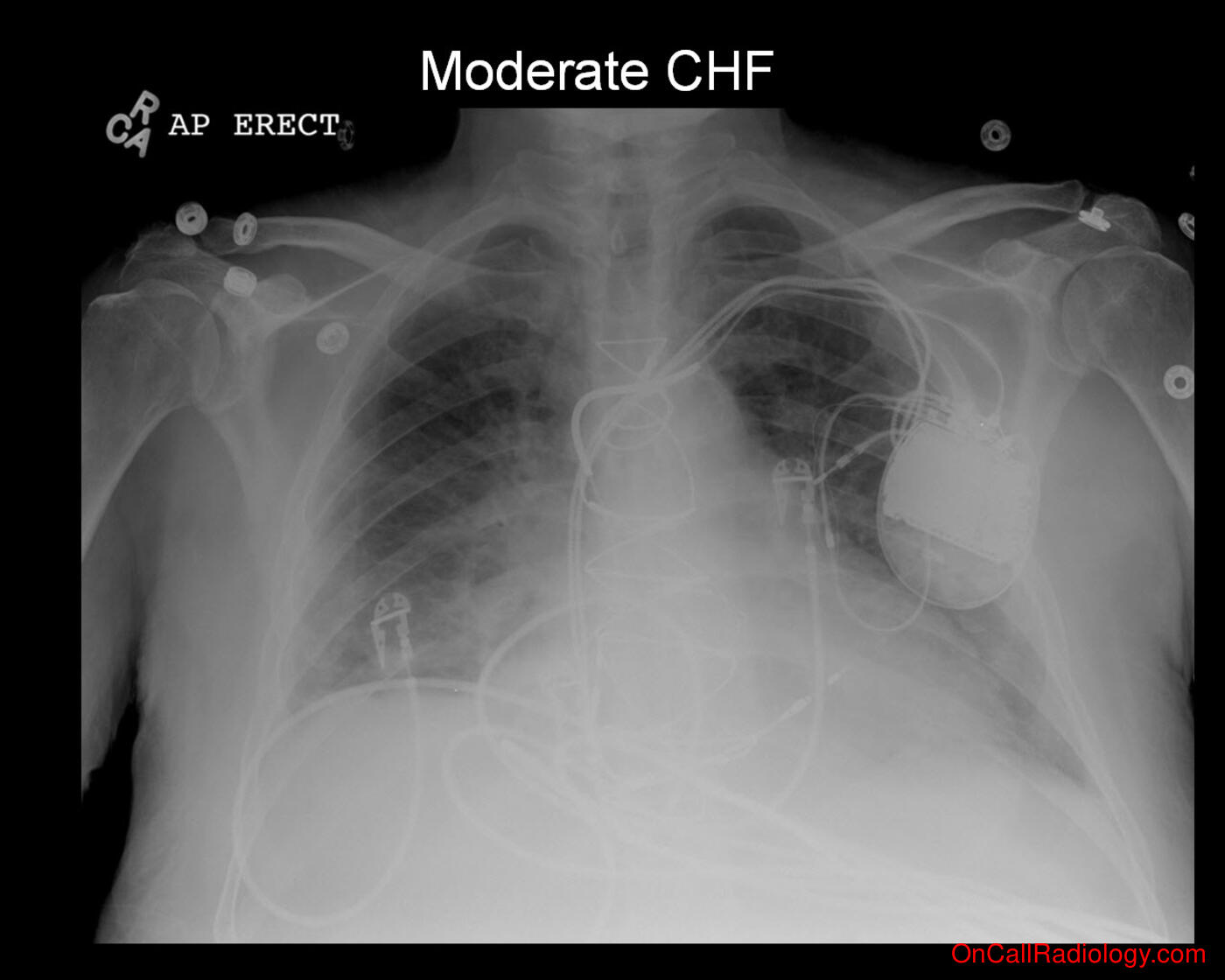 CHF (Moderate CHF - Plain film, Radiograph)