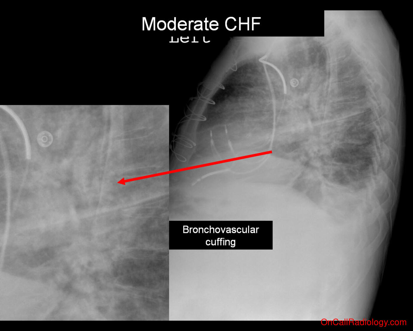 CHF (Moderate CHF - Plain film, Radiograph)