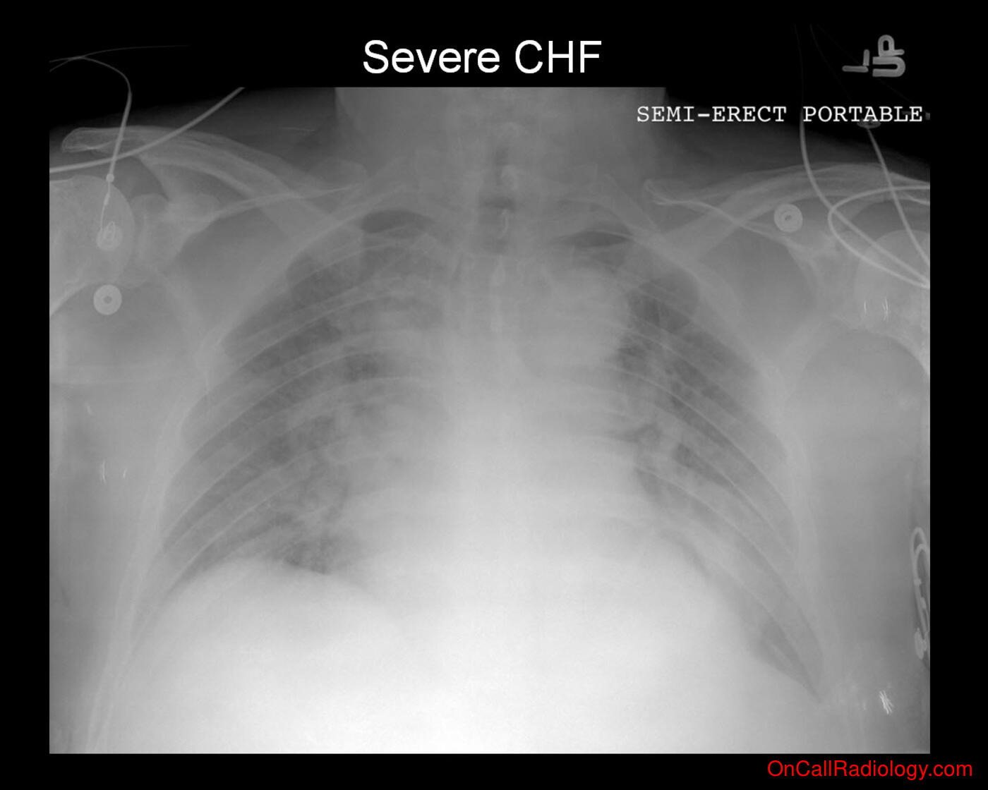CHF (Severe CHF - Plain film, Radiograph)