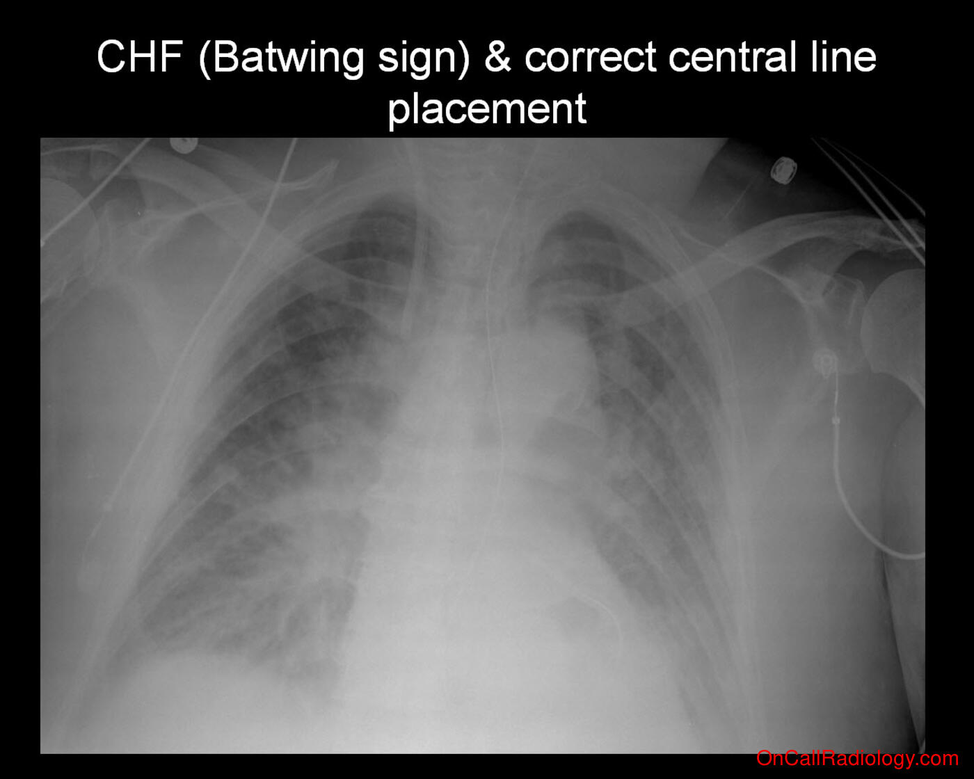 CHF (Severe CHF (Batwing sign) & correct central line placement - Plain film, Radiograph)