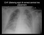 Severe CHF (Batwing sign) & correct central line placement
