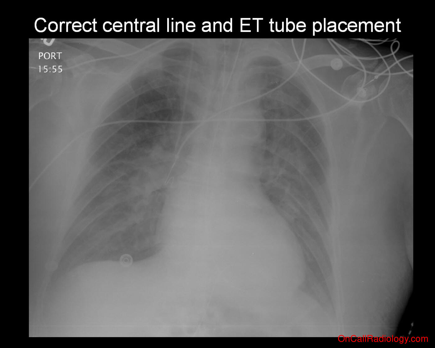 Tube and line misplacement (Endotracheal tube and central line placement - Plain film, Radiograph)