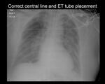 Endotracheal tube and central line placement