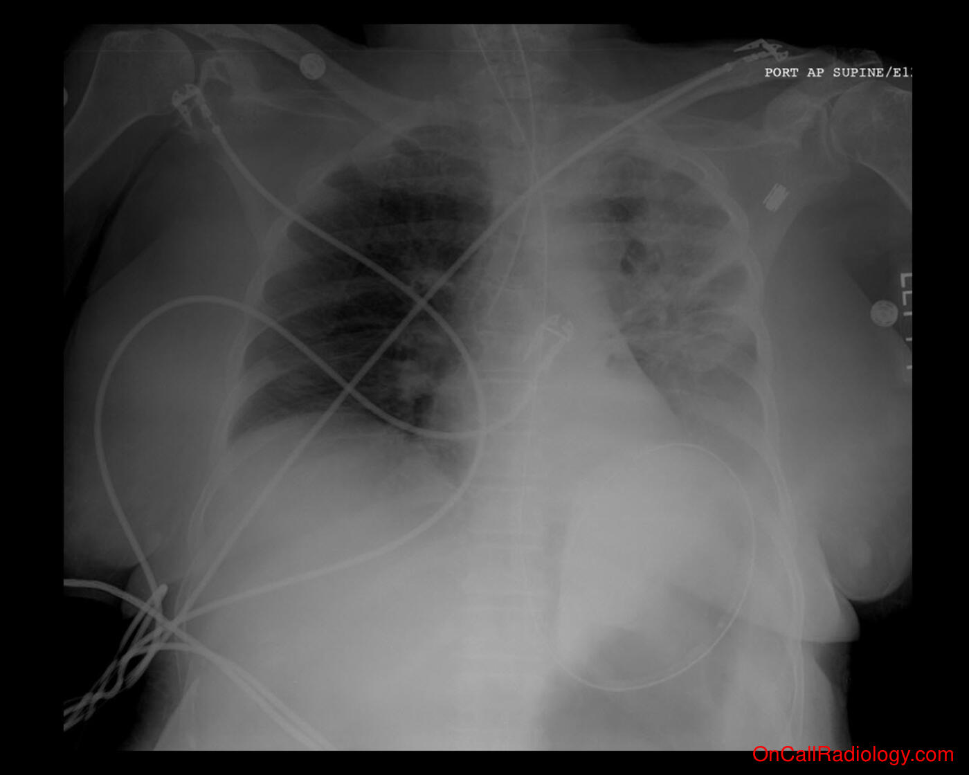 Tube and line misplacement (ET tube misplacement  - Plain film, Radiograph)