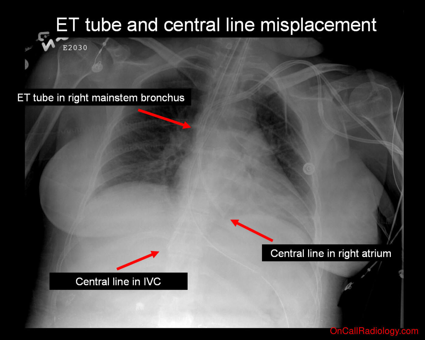 Tube and line misplacement (ET tube and central line misplacement - Plain film, Radiograph)