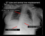 ET tube and central line misplacement