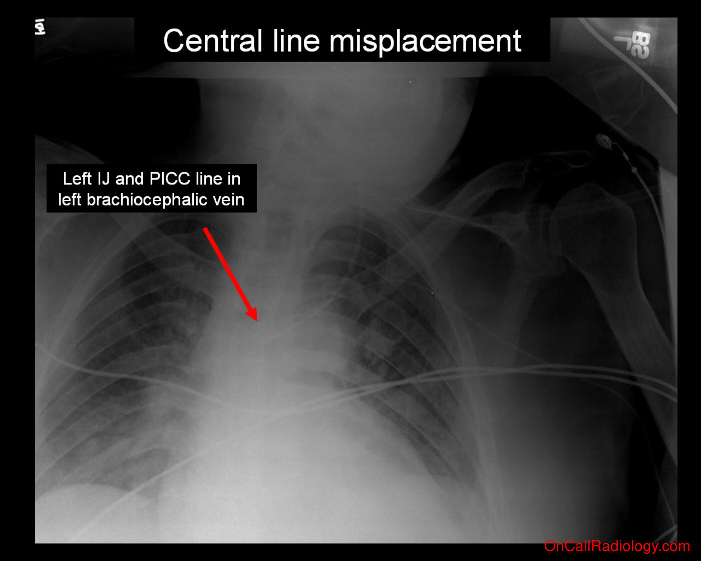 Tube and line misplacement (Central line misplacement  - Plain film, Radiograph)