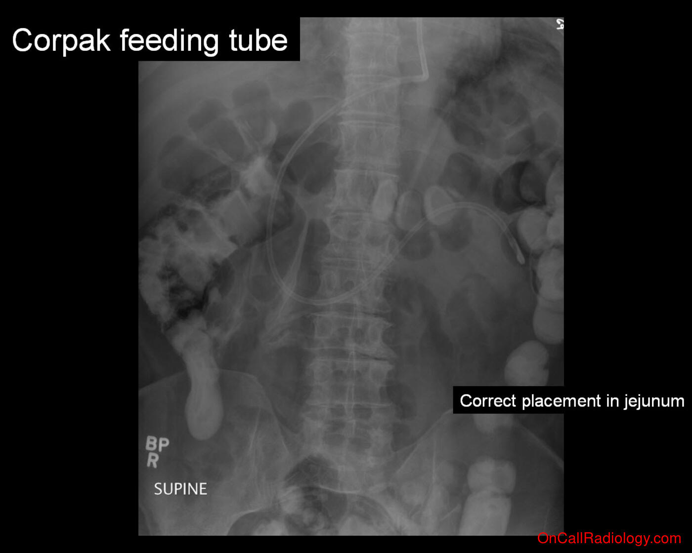 Feeding tube (Corpak feeding tube - Plain film, Radiograph)
