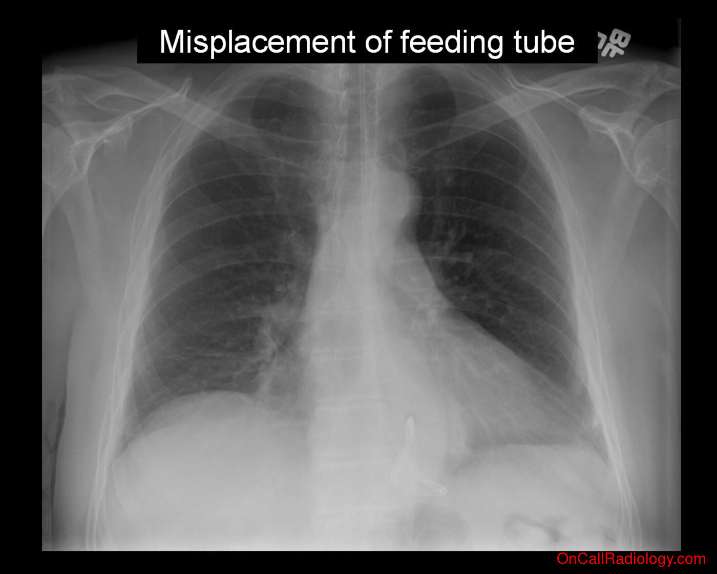 Feeding tube (Misplaced feeding tube - Plain film, Radiograph)