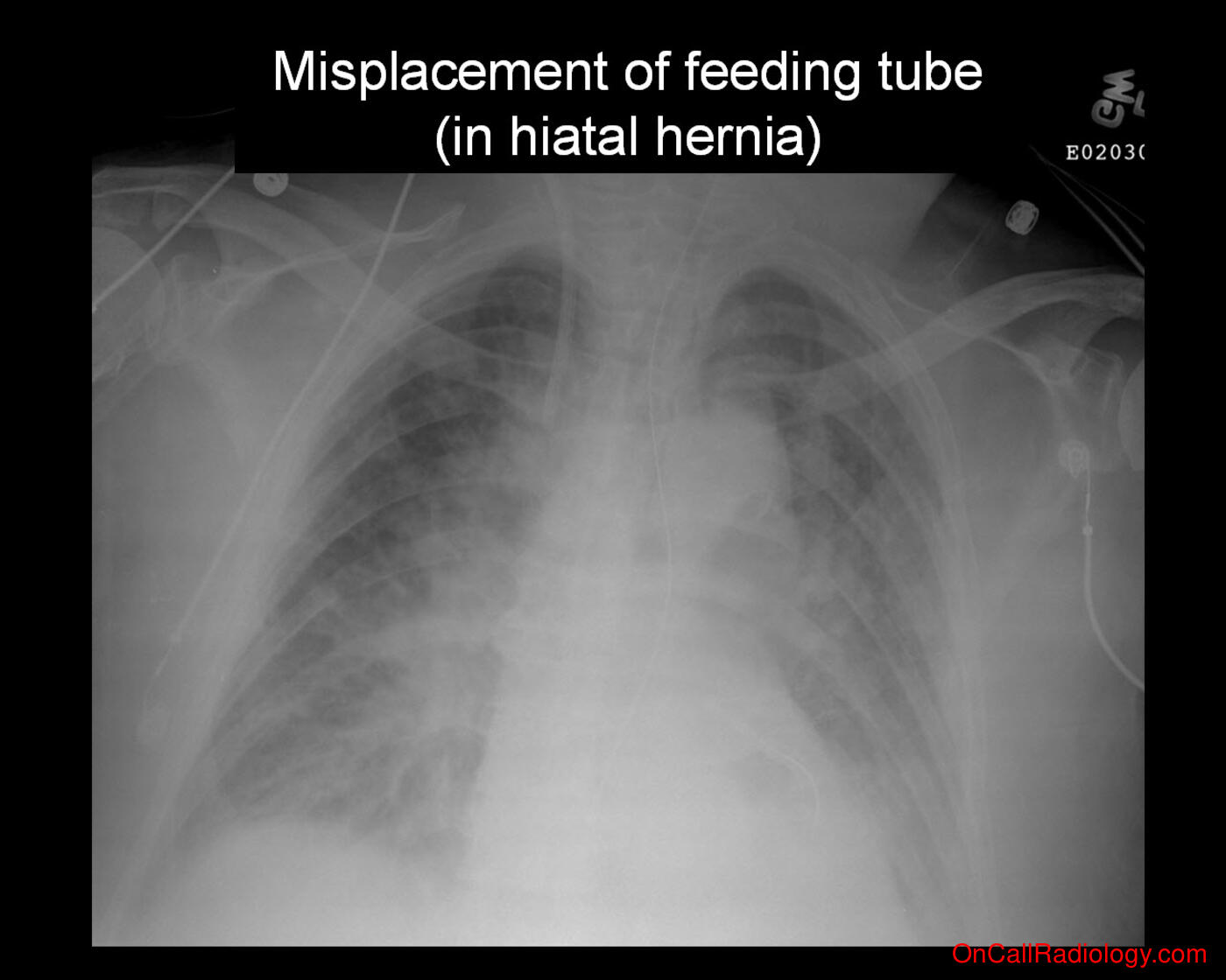 Feeding tube (Misplacement of feeding tube (in hiatal hernia)  - Plain film, Radiograph)