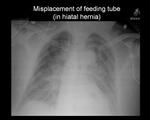 Misplacement of feeding tube (in hiatal hernia) 